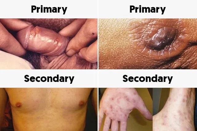 SYPHILIS